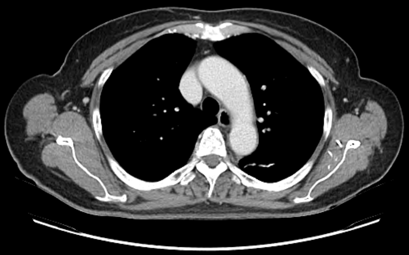 Follow-up contrast-enhanced chest computed tomography (CT)
demonstrating complete resolution of vascular wall thickening at 4 weeks
after initiation of corticosteroid therapy.