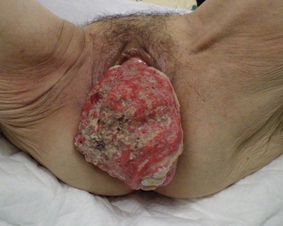 Preoperative examination. 
A mass with a coarse, irregular surface accompanied by hemorrhage and ulceration 
was present on the portion of the uterine cervix that had prolapsed beyond the 
vaginal introitus.