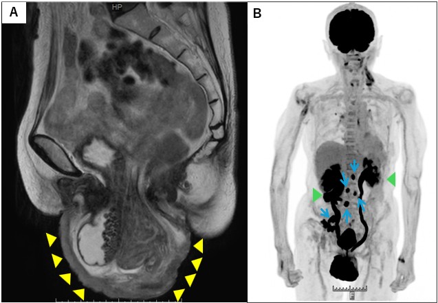 Preoperative images. (A) 
Magnetic Resonance Imaging (MRI) axial T2-weighted image, and (B) Positron 
Emission Tomography-Computed Tomography (PET-CT) image. Yellow arrow-heads show 
the cervical tumor, green arrow-heads show the bilateral hydronephrosis, and blue 
arrows show the FDG uptake by the para-aortic and right obturator lymph nodes.