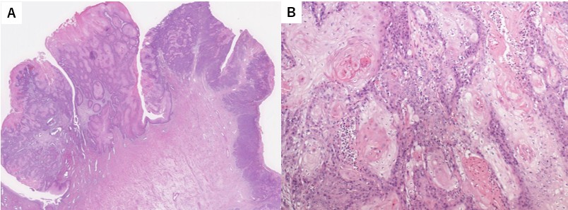 Pathological findings of 
the cervical tumor. Hematoxylin and eosin staining at weak magnification 
(×40, A) and strong magnification (×200, B).