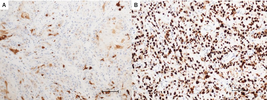 Immunohistochemical 
staining. (A) p16 expression in the cervical tumor (×200). (B) p53 
expression in cervical tumor cells in the area of stromal invasion 
(×200).